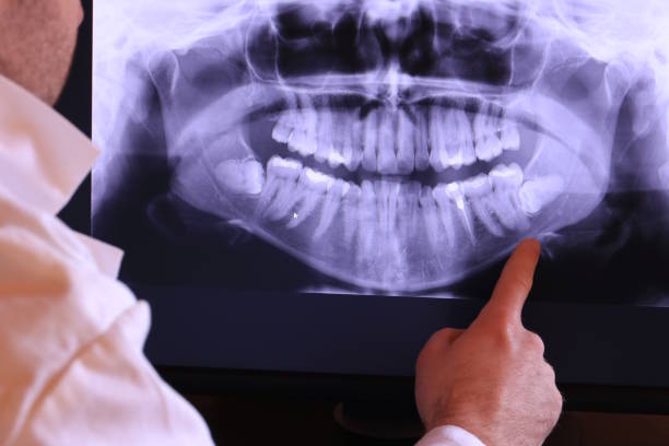 Best Emergency Dental Extractions in Morrow, GA